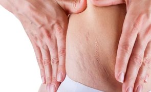 Estrias e musculação como cuidar e evitar