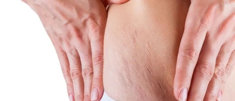 Estrias e musculação como cuidar e evitar: As melhores dicas estão aqui! Estrias e musculação como cuidar e evitar: As melhores dicas estão aqui!